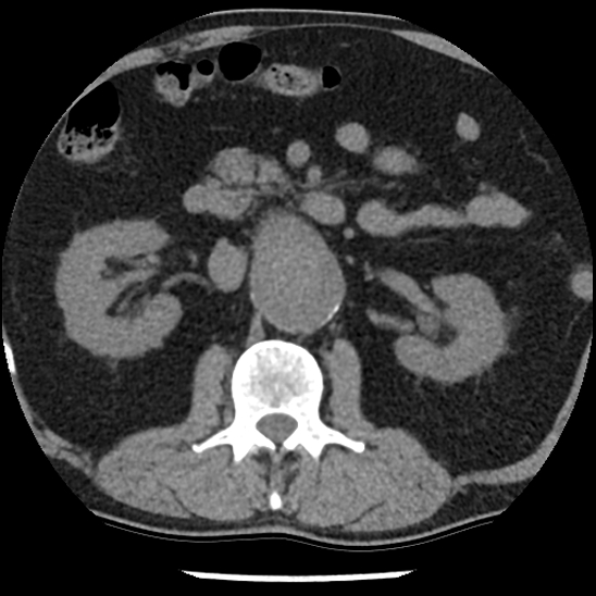 Aortic intramural hematoma (type B) (Radiopaedia 79323-92387 Axial non-contrast 67).jpg