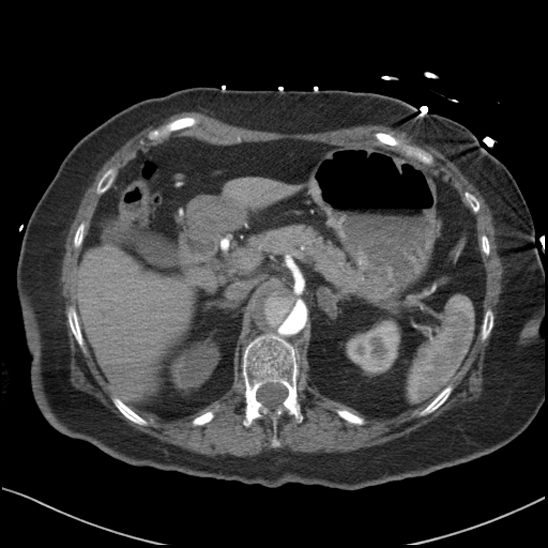 Aortic intramural hematoma with dissection and intramural blood pool (Radiopaedia 77373-89491 B 112).jpg