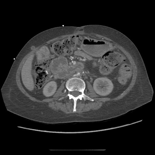 Aorto-duodenal fistula (Radiopaedia 25668-25850 A 39).jpg
