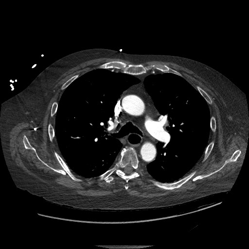 Aortoesophageal fistula with endovascular repair (Radiopaedia 73781-84592 Axial C+ CTPA 52).jpg
