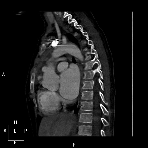 File:Aortopulmonary septal defect (Radiopaedia 41990-45013 Sagittal C+ CTPA 25).jpg
