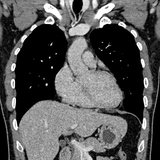 Apical lung mass mimic - neurogenic tumor (Radiopaedia 59918-67521 B 52).jpg