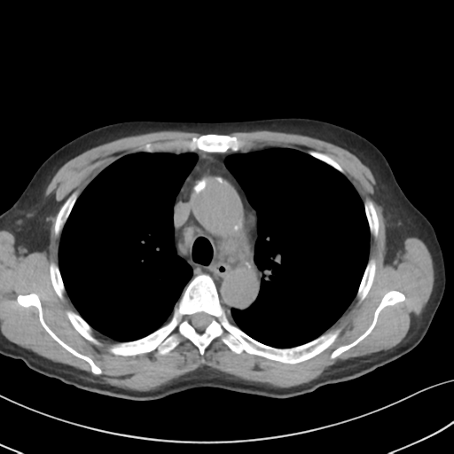 Apical pulmonary metastasis (Radiopaedia 46338-50754 B 23).png