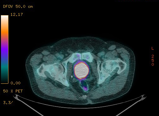 Appendiceal adenocarcinoma complicated by retroperitoneal abscess (Radiopaedia 58007-65041 Axial PET-CT 188).jpg