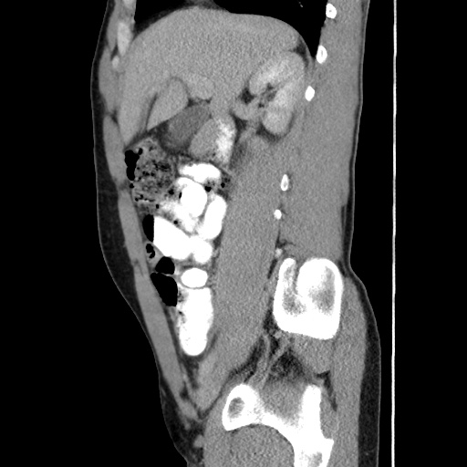 Appendicitis complicated by post-operative collection (Radiopaedia 35595-37114 C 28).jpg