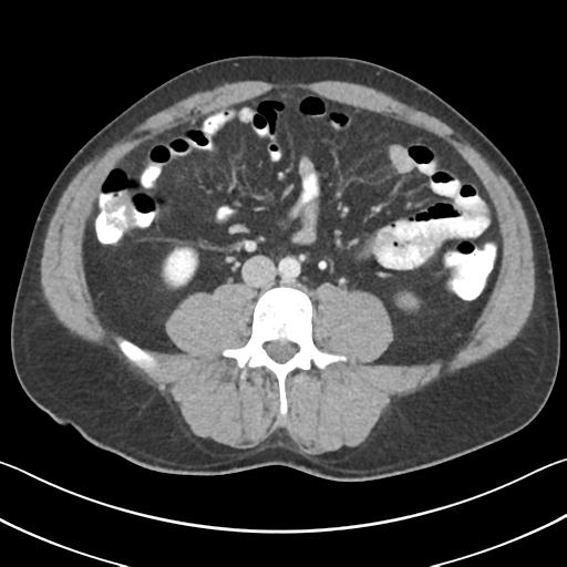 File:Appendicitis with cecal bar sign (Radiopaedia 31878-32830 B 46).jpg