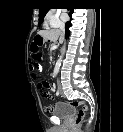 Appendicitis with localized perforation and abscess formation (Radiopaedia 49035-54130 C 31).jpg
