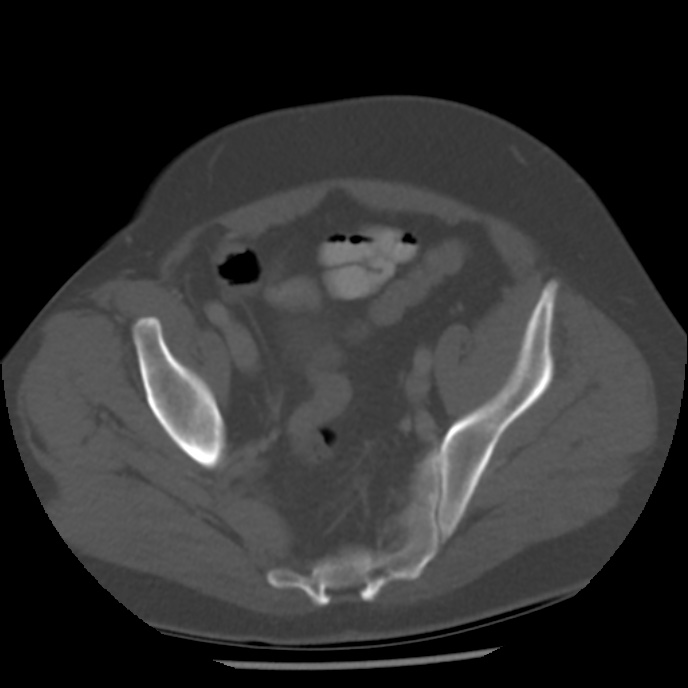 Appendicitis with perforation (Radiopaedia 35790-37342 Axial bone window 44).jpg