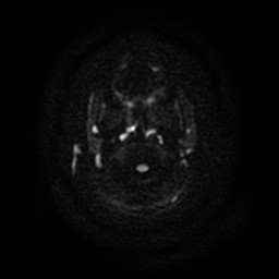 Arachnoid cyst - middle cranial fossa (Radiopaedia 86780-102938 Axial DWI 28).jpg