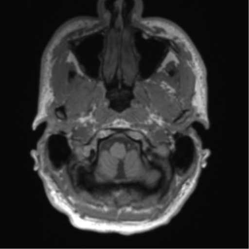 File:Arachnoid cyst with subdural hematoma (Radiopaedia 85892-101743 Axial T1 13).png
