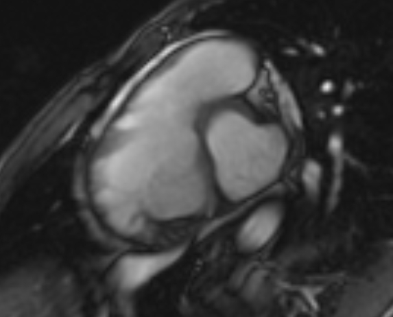 Arrhythmogenic right ventricular cardiomyopathy (Radiopaedia 69564-79464 short axis cine 224).jpg
