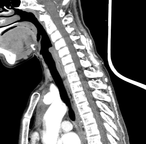 File:Arteriovenous malformation of the neck (Radiopaedia 53935-60062 C 64).jpg