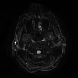 File:Artery of Percheron infarct (Radiopaedia 48088-52928 Axial DWI 3).jpg