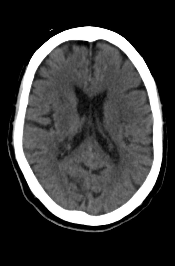 Artery of Percheron infarction (Radiopaedia 80613-94202 Axial non-contrast 112).jpg