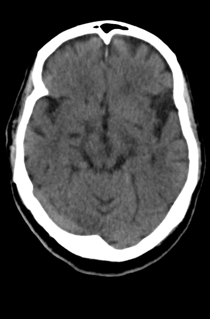 Artery of Percheron infarction (Radiopaedia 80613-94202 Axial non-contrast 80).jpg