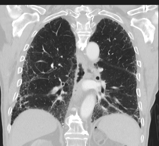 Asbestosis (Radiopaedia 56192-62864 Coronal lung window 34).png