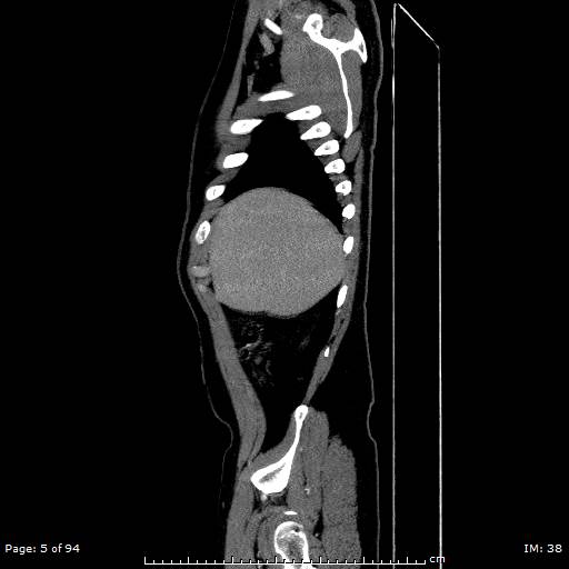 File:Ascending aortic aneurysm (Radiopaedia 50086-55404 C 4).jpg