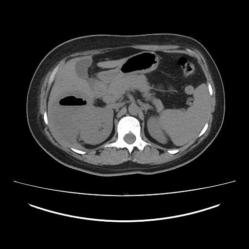 File:Ascending retrocecal appendicitis with liver abscesses (Radiopaedia 60066-67615 Axial non-contrast 28).jpg