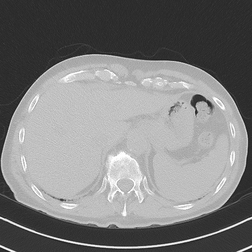Aspergilloma on background pulmonary fibrosis (Radiopaedia 60942-68757 A 51).jpg