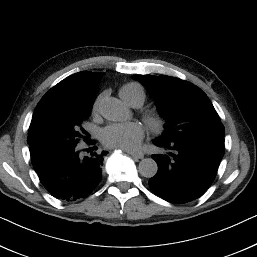 File:Aspergilloma on background pulmonary fibrosis (Radiopaedia 60942-68757 Axial non-contrast 33).jpg