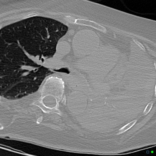 File:Aspirated food bolus obstruction of left main bronchus (Radiopaedia 29432-29904 Axial non-contrast 13).jpg