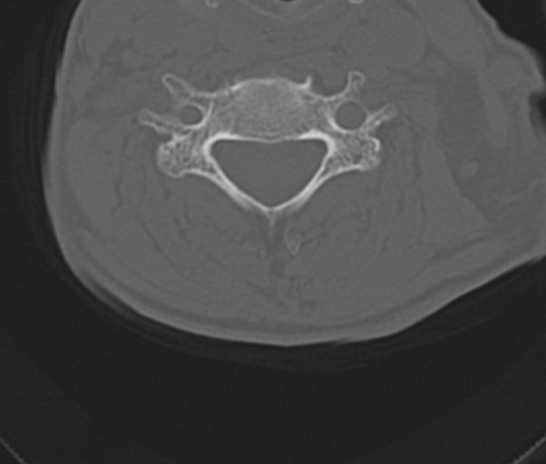 Atlanto-axial subluxation (Radiopaedia 36610-38176 Axial bone window 34).png