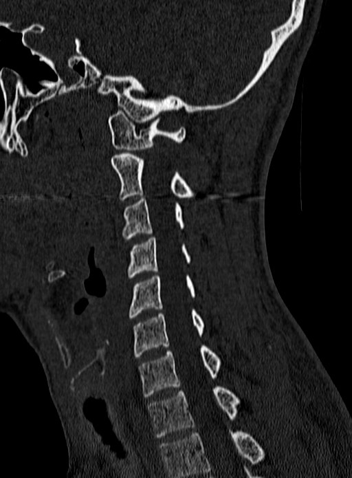 Atlantoaxial subluxation (Radiopaedia 44681-48450 Sagittal bone window 101).jpg