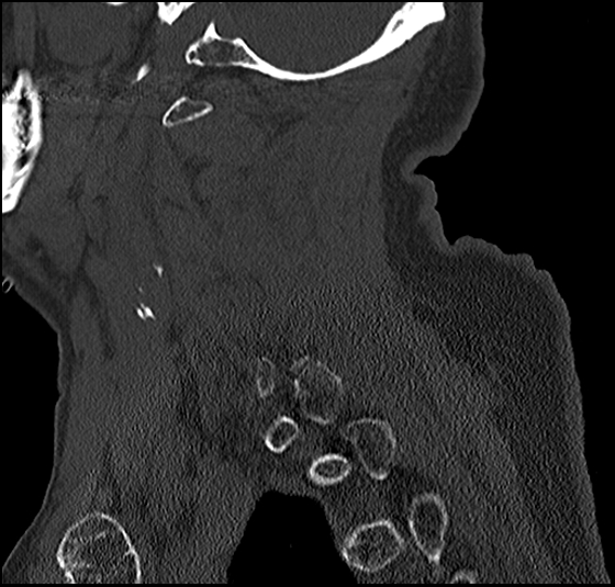 Atlas (type 3b subtype 1) and axis (Anderson and D'Alonzo type 3, Roy-Camille type 2) fractures (Radiopaedia 88043-104607 Sagittal bone window 26).jpg