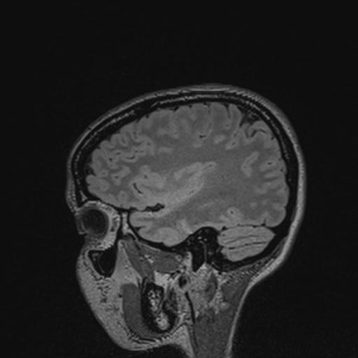 Atretic encephalocoele with inferior vermis hypoplasia (Radiopaedia 30443-31108 Sagittal FLAIR 47).jpg