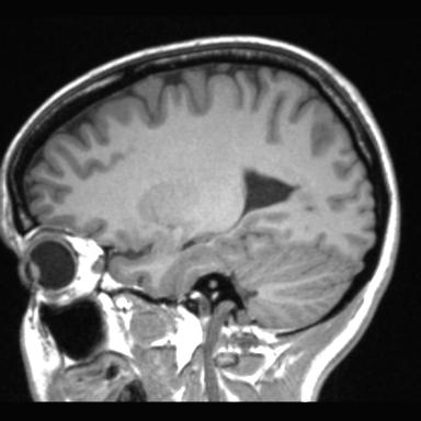 Atretic encephalocoele with inferior vermis hypoplasia (Radiopaedia 30443-31108 Sagittal T1 40).jpg