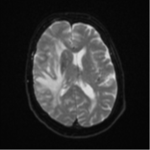 Atypical meningioma (WHO Grade II) (Radiopaedia 54742-60979 Axial DWI 16).png