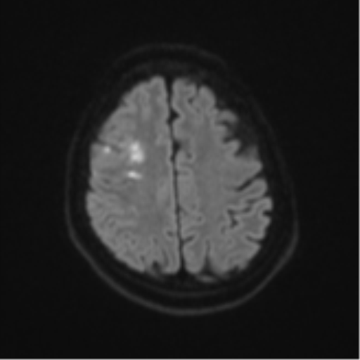 Atypical meningioma (WHO Grade II) (Radiopaedia 54742-60979 Axial DWI 49).png