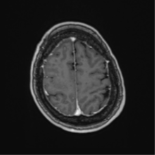 Atypical meningioma (WHO Grade II) (Radiopaedia 54742-60981 Axial T1 C+ 58).png