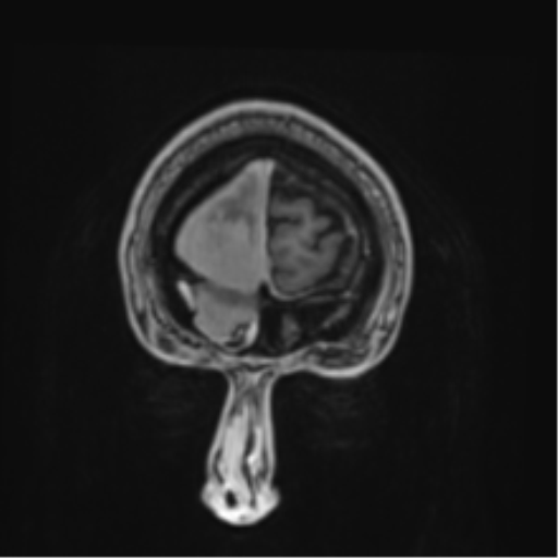 Atypical meningioma (WHO grade II) with brain invasion (Radiopaedia 57767-64729 Coronal T1 C+ 1).png