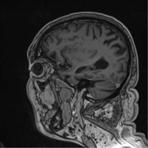 Atypical meningioma (WHO grade II) with brain invasion (Radiopaedia 57767-64729 Sagittal T1 C+ 24).png