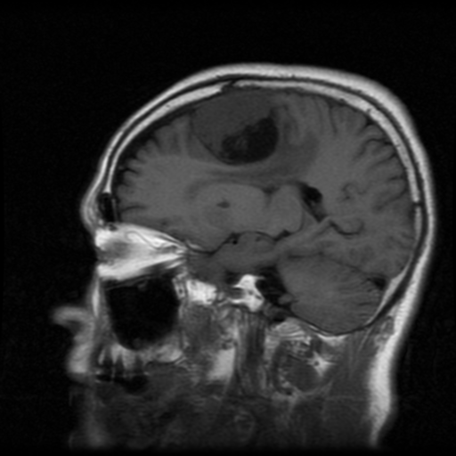 File:Atypical meningioma with skull invasion (Radiopaedia 34357-35648 Sagittal T1 15).png