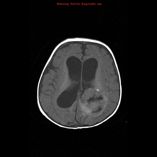 File:Atypical teratoid rhabdoid tumor (Radiopaedia 10712-11183 Axial T1 7).jpg