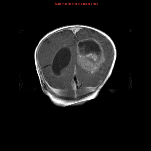 File:Atypical teratoid rhabdoid tumor (Radiopaedia 10712-11183 Coronal T1 C+ 4).jpg