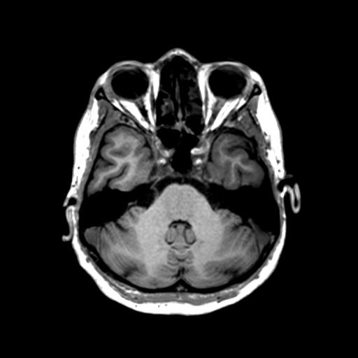 Autoimmune limbic encephalitis (Radiopaedia 30363-31005 T1 Axial 1mm 45).jpg
