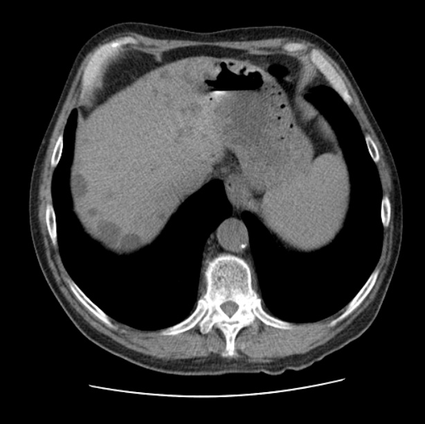 Autosomal dominant polycystic kidney disease (Radiopaedia 27851-28094 Axial non-contrast 48).jpg