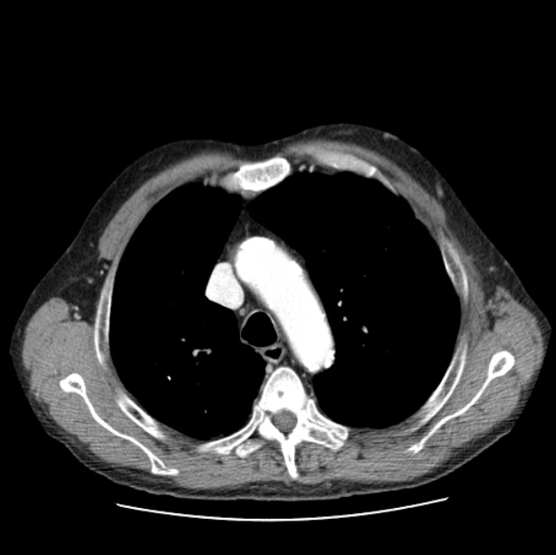 Autosomal dominant polycystic kidney disease (Radiopaedia 27851-28094 B 18).jpg
