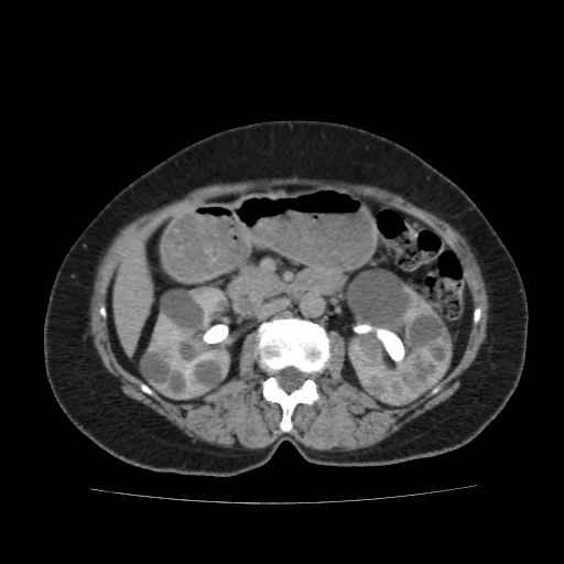 Autosomal dominant polycystic kidney disease (Radiopaedia 38189-40194 Axial C+ delayed 20).jpg
