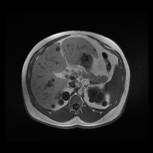Autosomal dominant polycystic kidney disease (Radiopaedia 50259-55611 Axial 2D Dual Echo 34).jpg