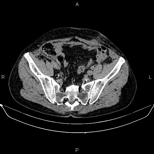 File:Autosomal dominant polycystic kidney disease (Radiopaedia 87830-104287 Axial non-contrast 45).jpg