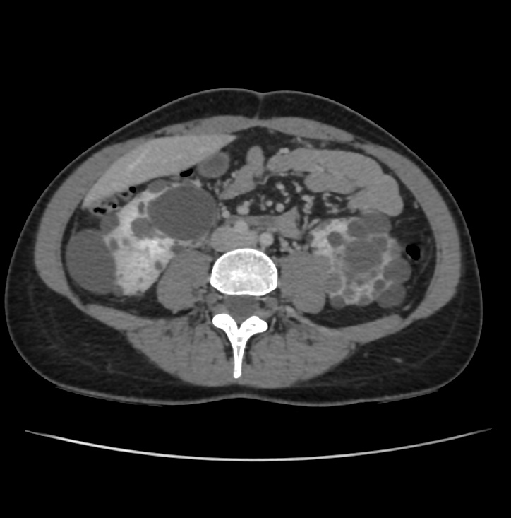 Autosomal dominant polycystic kidney disease - early onset (Radiopaedia 40734-43387 A 50).jpg