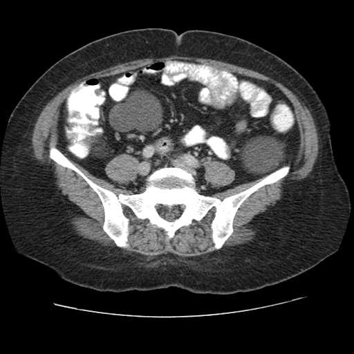 Autosomal dominant polycystic kidney disease with hepatic involvement (Radiopaedia 32693-33662 B 56).jpg