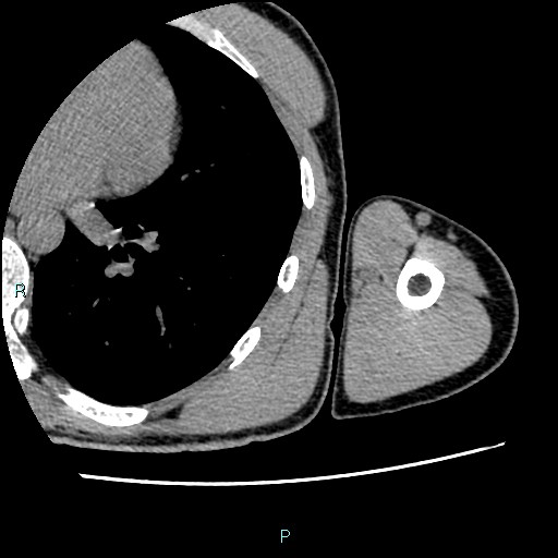 File:Avascular necrosis after fracture dislocations of the proximal humerus (Radiopaedia 88078-104655 D 109).jpg