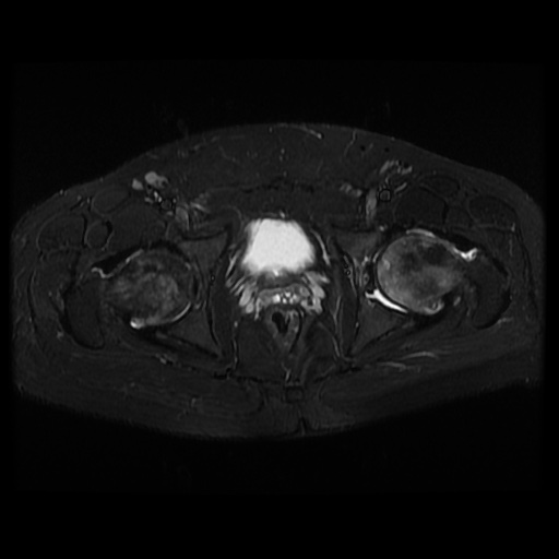 File:Avascular necrosis of the hip (Radiopaedia 61503-69465 Axial STIR 18).jpg