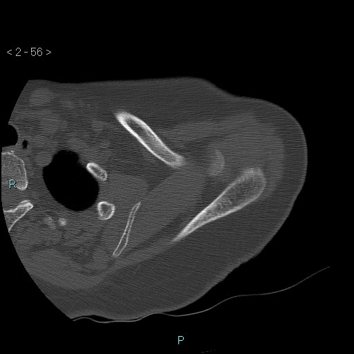 Avascular necrosis of the shoulder - Cruess stage I (Radiopaedia 77674-89887 Axial bone window 14).jpg