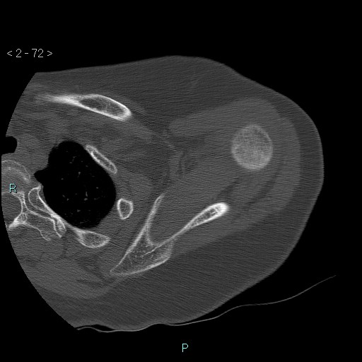 Avascular necrosis of the shoulder - Cruess stage I (Radiopaedia 77674-89887 Axial bone window 18).jpg